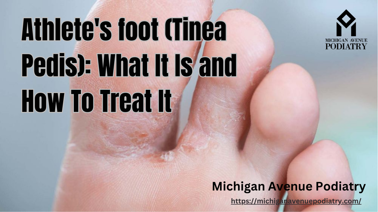Athlete's Foot (Tinea Pedis): What It Is And How To Treat It