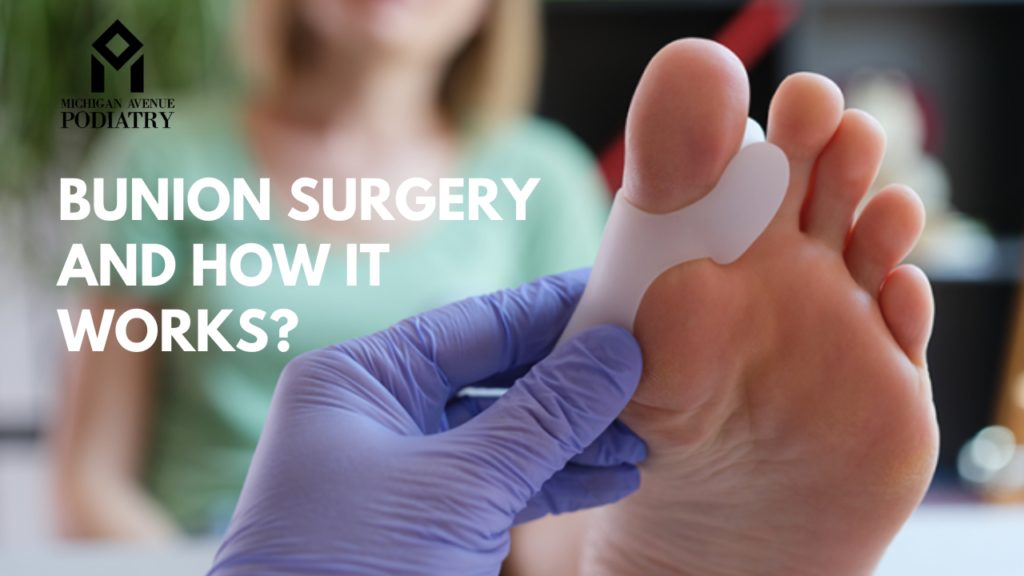 Bunion Surgery