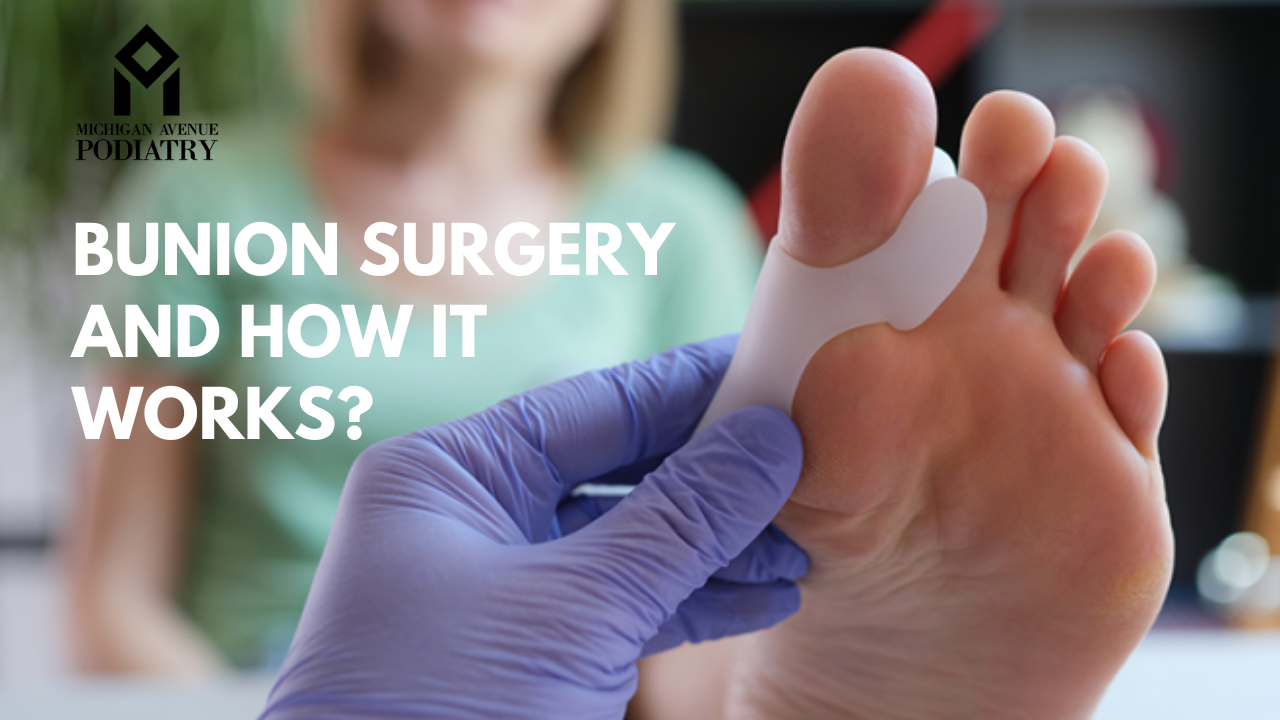 You are currently viewing Bunion Surgery And How It Works?