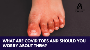 Read more about the article What are COVID Toes and Should You Worry about Them?