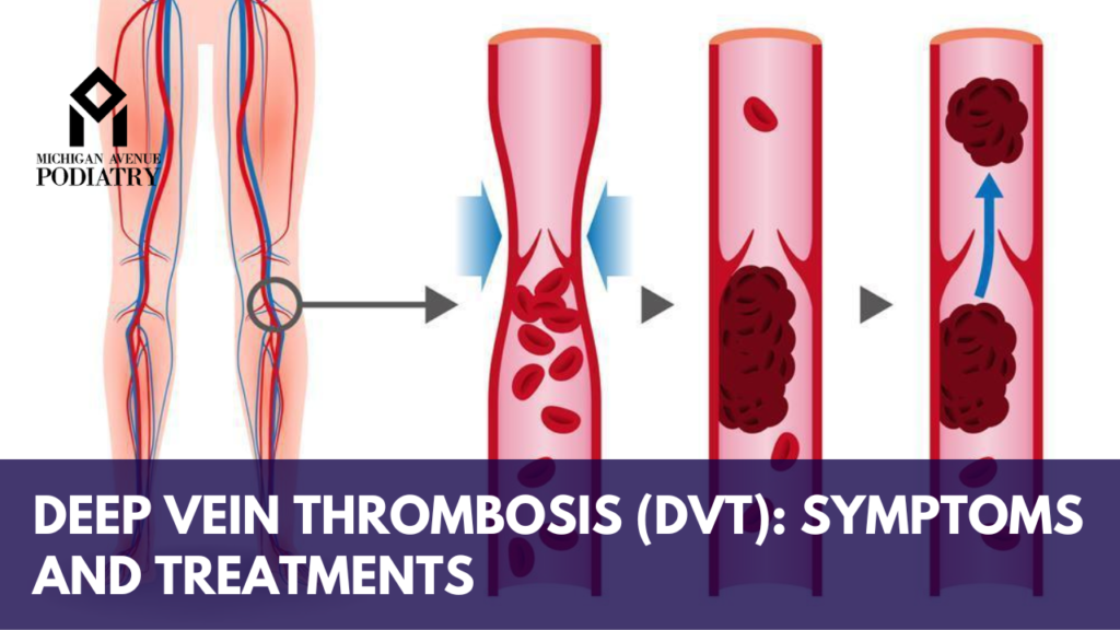 Deep Vein Thrombosis (DVT): Symptoms And Treatments