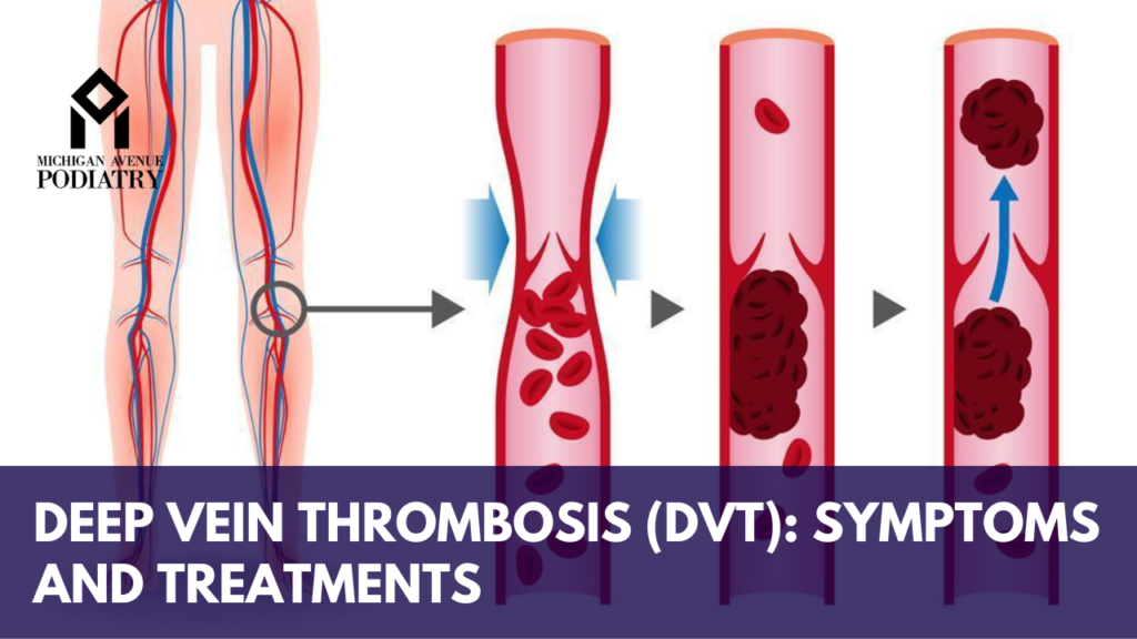 Deep Vein Thrombosis DVT Symptoms And Treatments