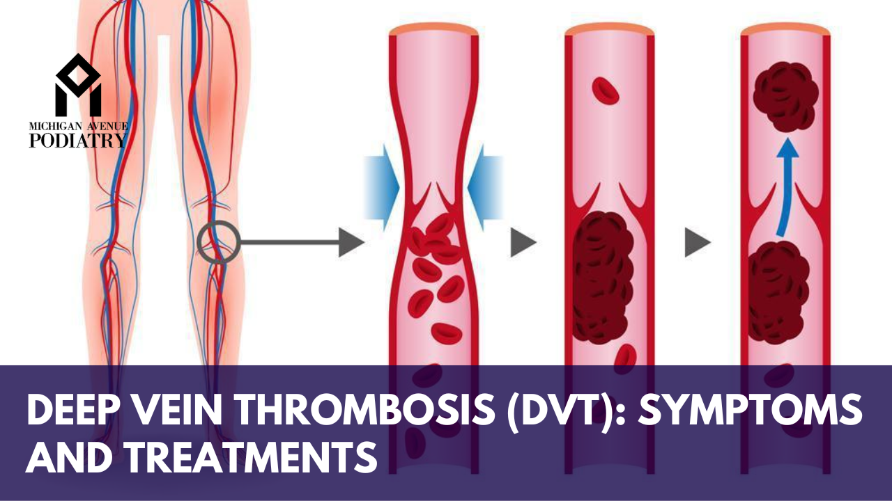 Read more about the article Deep Vein Thrombosis (DVT): Understanding Symptoms and Treatments