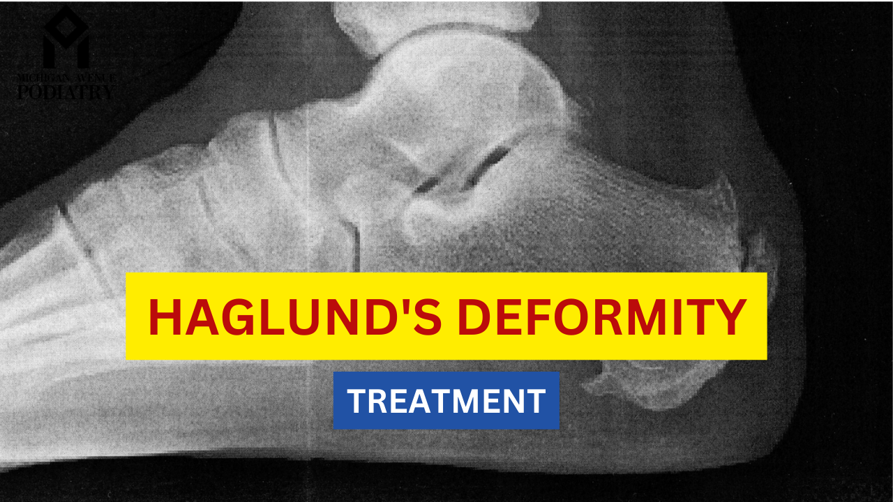 You are currently viewing Haglund’s Deformity: A Chiropractic Treatment Guide
