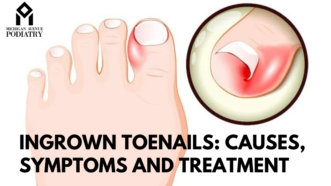 Symptoms and Treatments for Ingrown Toenails