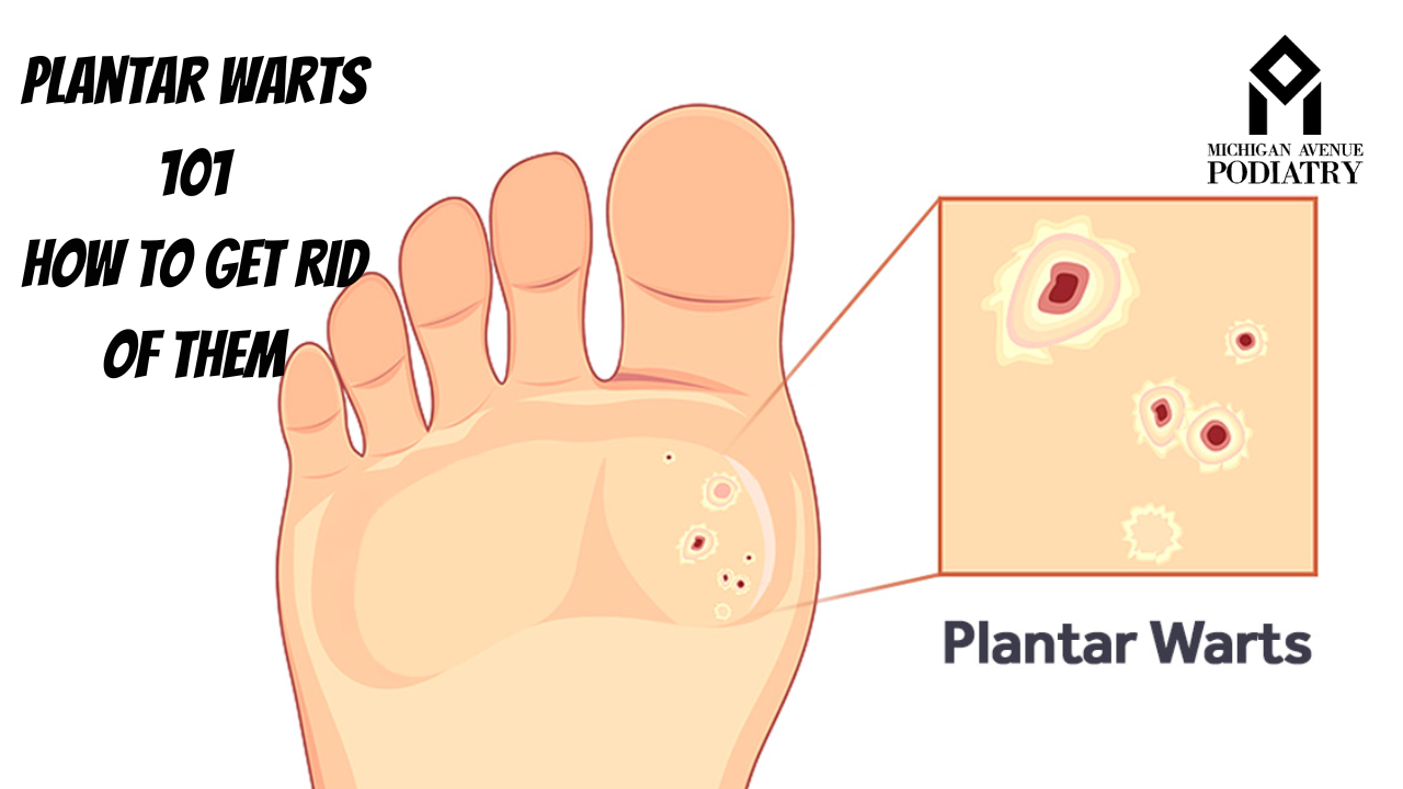 Read more about the article Plantar Warts 101: How to Get Rid of Them