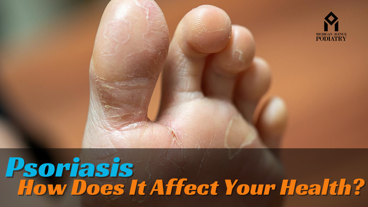 You are currently viewing Psoriasis: How Does It Affect Your Health?