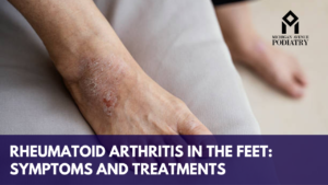 Read more about the article Rheumatoid Arthritis in The Feet: Symptoms and Treatments