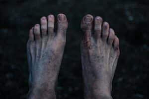 Read more about the article Bunions and Hammertoes – Michigan Avenue Podiatry