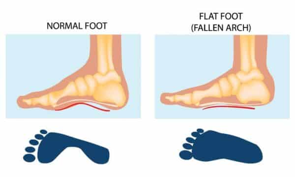 Flat Feet Specialist: Expert Podiatrist Chicago, IL