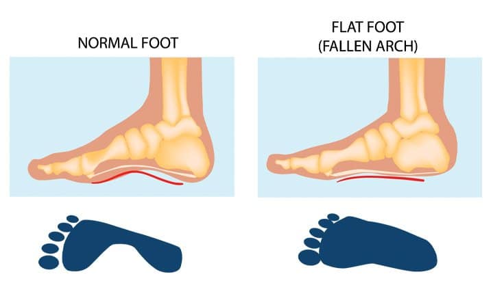 Flatfoot Treatment in Chicago Flatfoot Treatment in Elmhurst flatfoot treatment near me