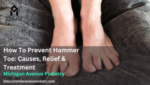 Read more about the article How To Prevent Hammer Toe: A Comprehensive Guide For Hammer Toe