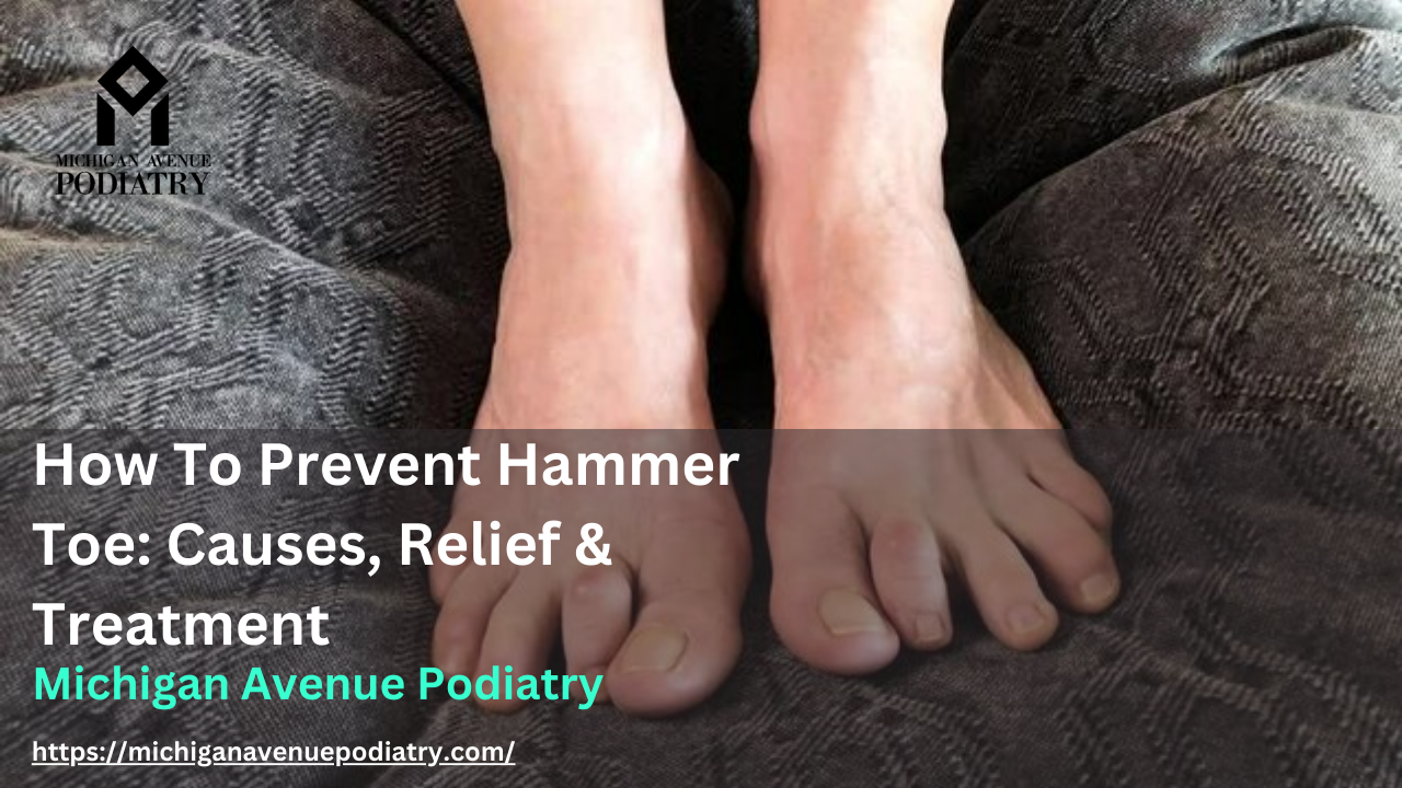 Hammertoes: What It Is, Causes, Relief & Treatment