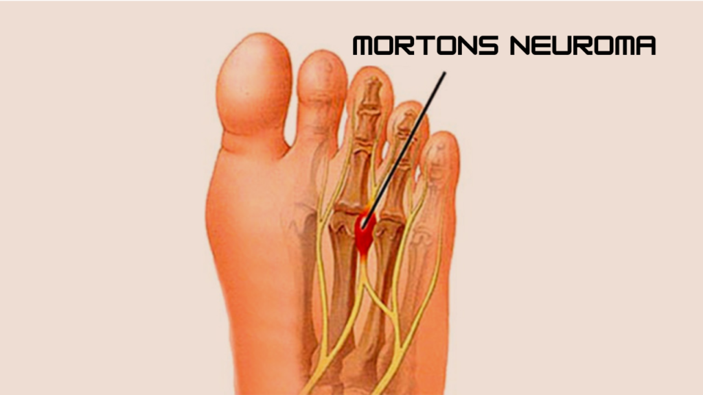 Mortons Neuroma Treatment