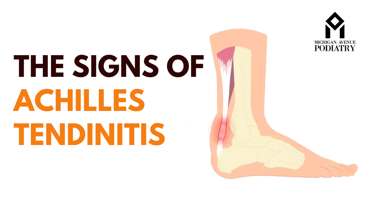 You are currently viewing The Signs of Achilles Tendinitis