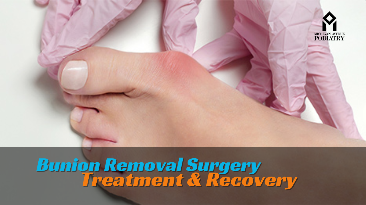 Read more about the article Bunion Removal Surgery: Treatment & Recovery