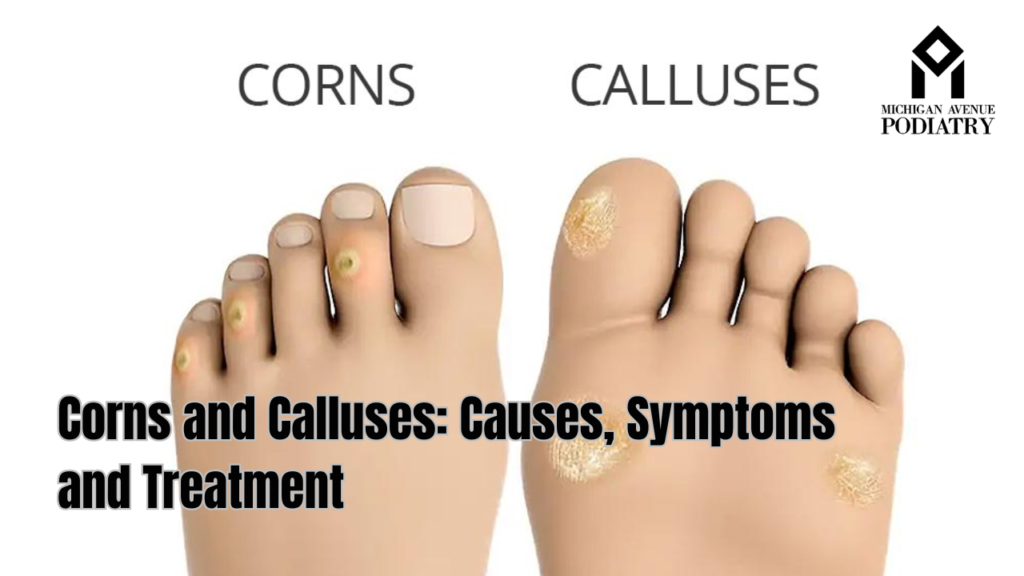 Corns and Calluses