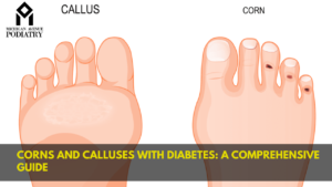 Read more about the article Corns and Calluses with Diabetes: A Comprehensive Guide