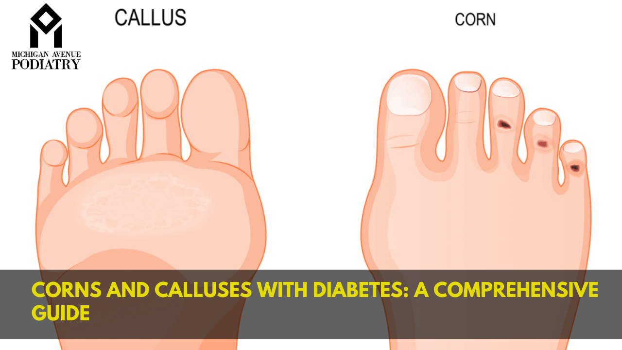 You are currently viewing Corns and Calluses with Diabetes: A Comprehensive Guide