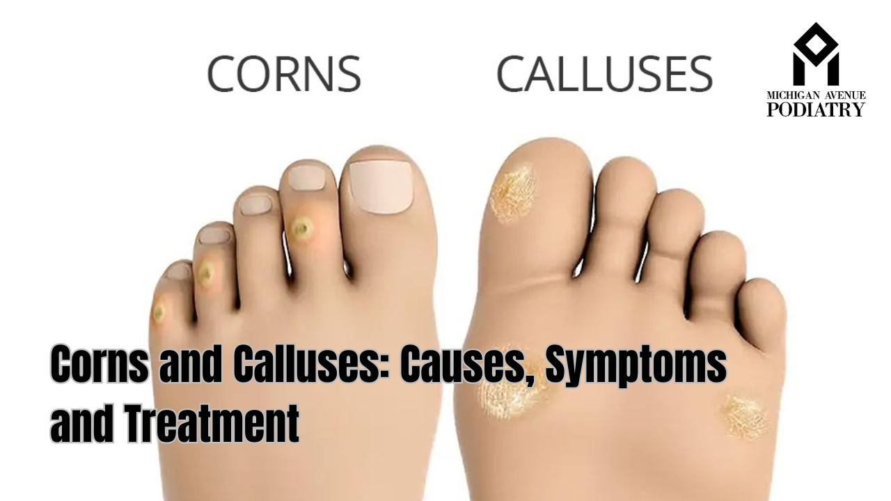 You are currently viewing Corns and Calluses: Causes, Symptoms and Treatment