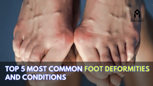 Read more about the article Top 5 Most Common Foot Deformities and Conditions