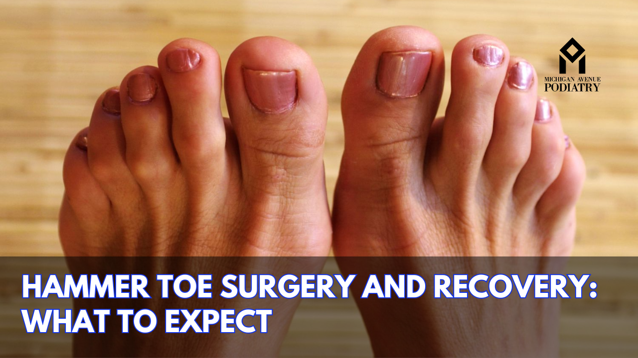 Read more about the article Hammer Toe Surgery And Recovery: What To Expect