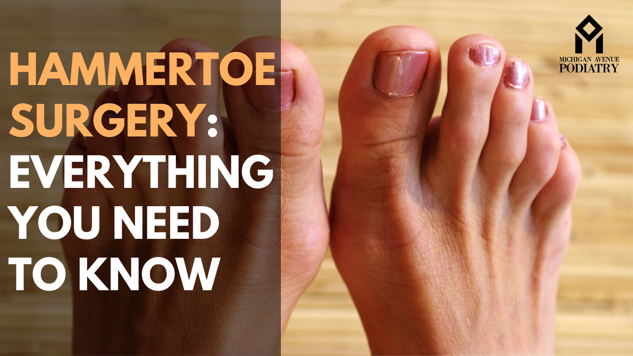 Read more about the article Hammertoe Surgery: Everything You Need to Know