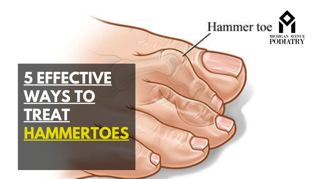 Hammertoes