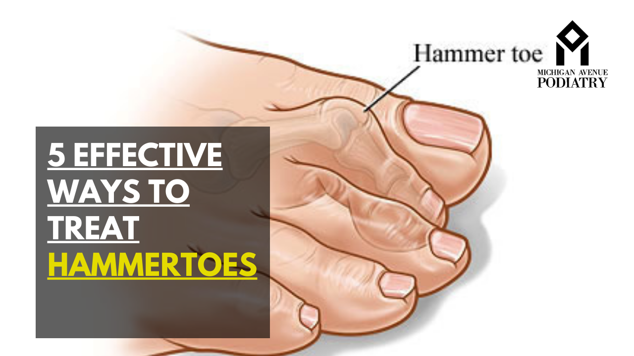 You are currently viewing 5 Effective Ways to Treat Hammertoes
