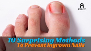 Read more about the article 10 Surprising Methods To Prevent Ingrown Nails