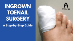 Read more about the article A Step-by-Step Guide to Ingrown Toenail Surgery and Recovery
