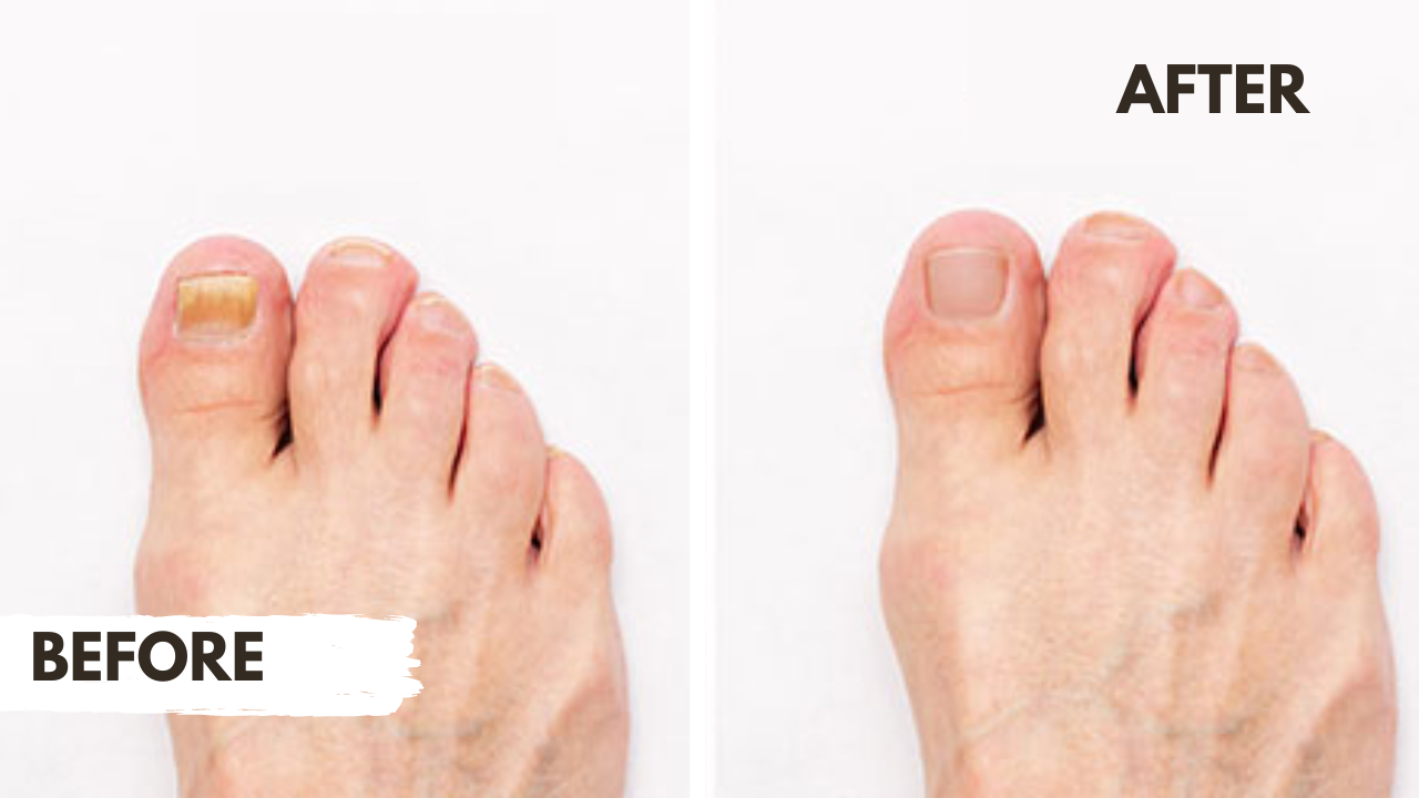 You are currently viewing Laser Toenail Fungus Treatment: What You Need to Know