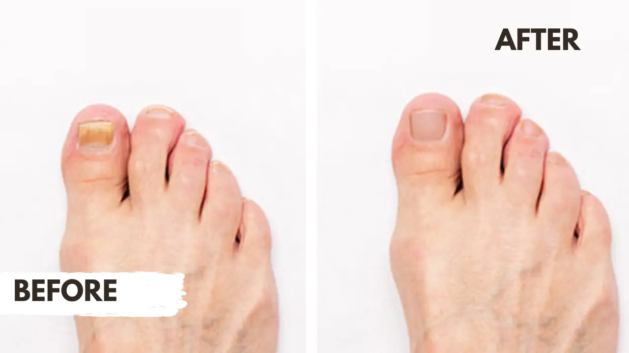Laser toenail fungus treatment Chicago &mdash; FDA-cleared laser nail therapy