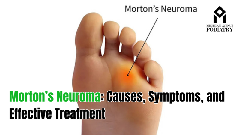 Morton's Neuroma: Causes, Symptoms, And Effective Treatment