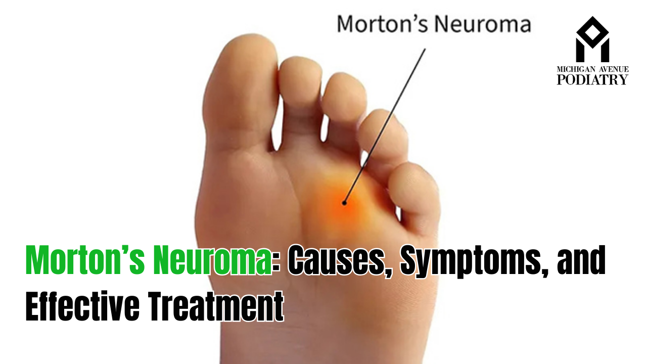 Read more about the article Morton’s Neuroma: Causes, Symptoms, and Effective Treatment