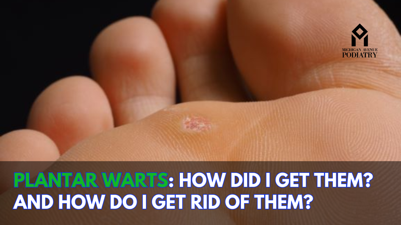 Read more about the article Plantar Warts: How Did I Get Them? And How Do I Get Rid Of Them?