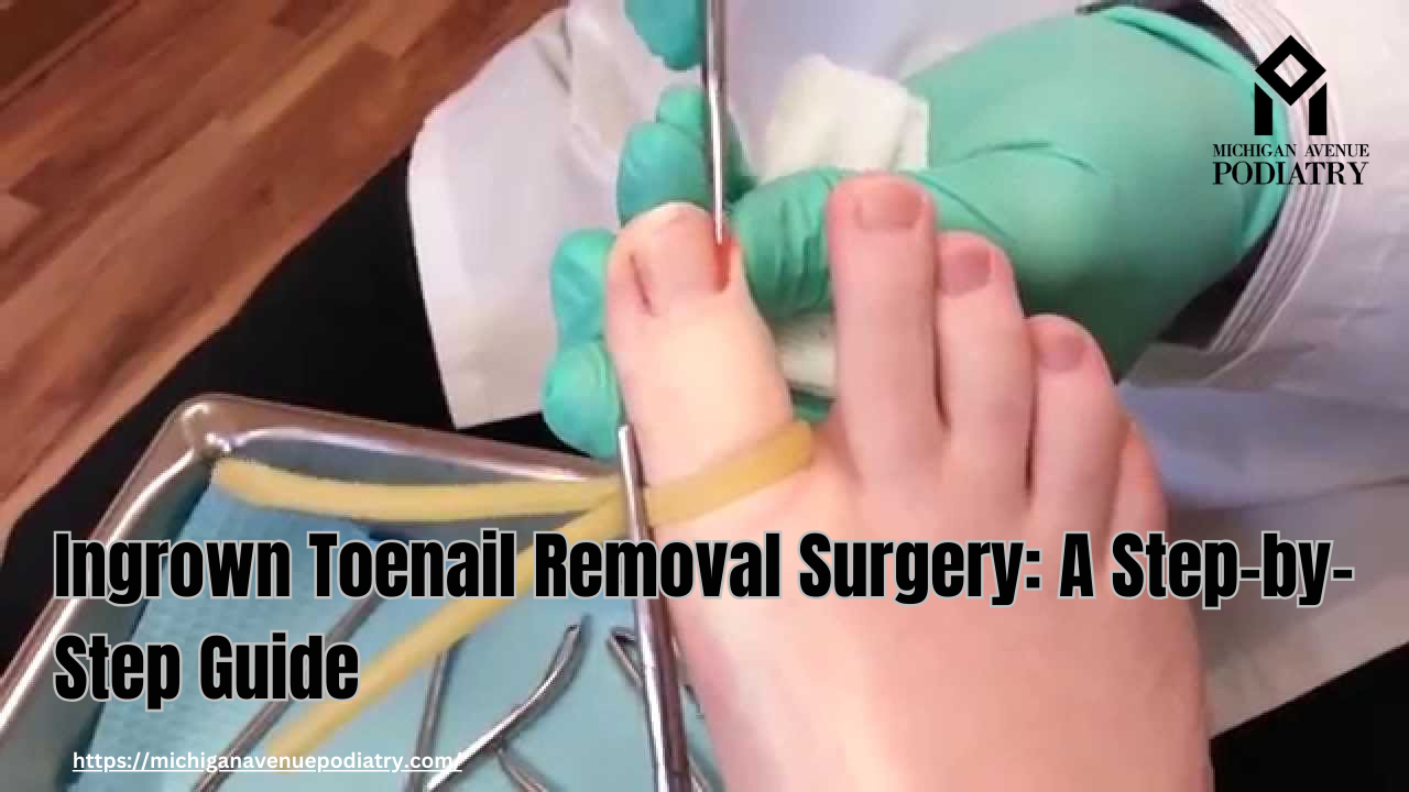 Read more about the article Ingrown Toenail Removal Surgery: A Step-by-Step Guide