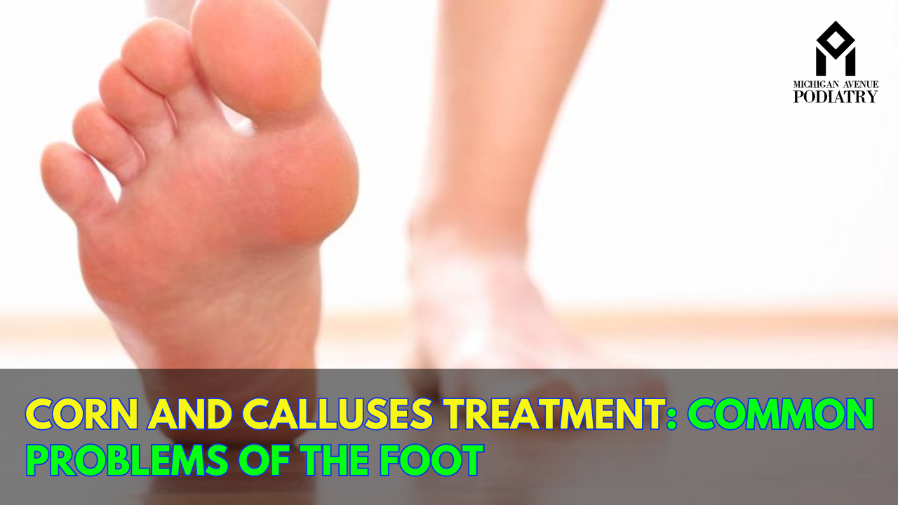 You are currently viewing Corn and Calluses Treatment: Common Problems of the Foot