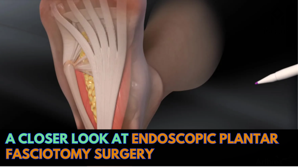 A Closer Look At Endoscopic Plantar Fasciotomy Surgery   Endoscopic Plantar Fasciotomy  1024x576 