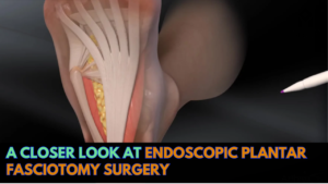 Read more about the article A Closer Look At Endoscopic Plantar Fasciotomy Surgery