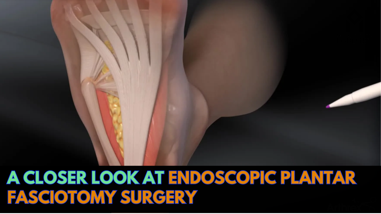 You are currently viewing A Closer Look At Endoscopic Plantar Fasciotomy Surgery
