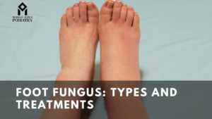 Read more about the article Foot fungus: Types and Treatments