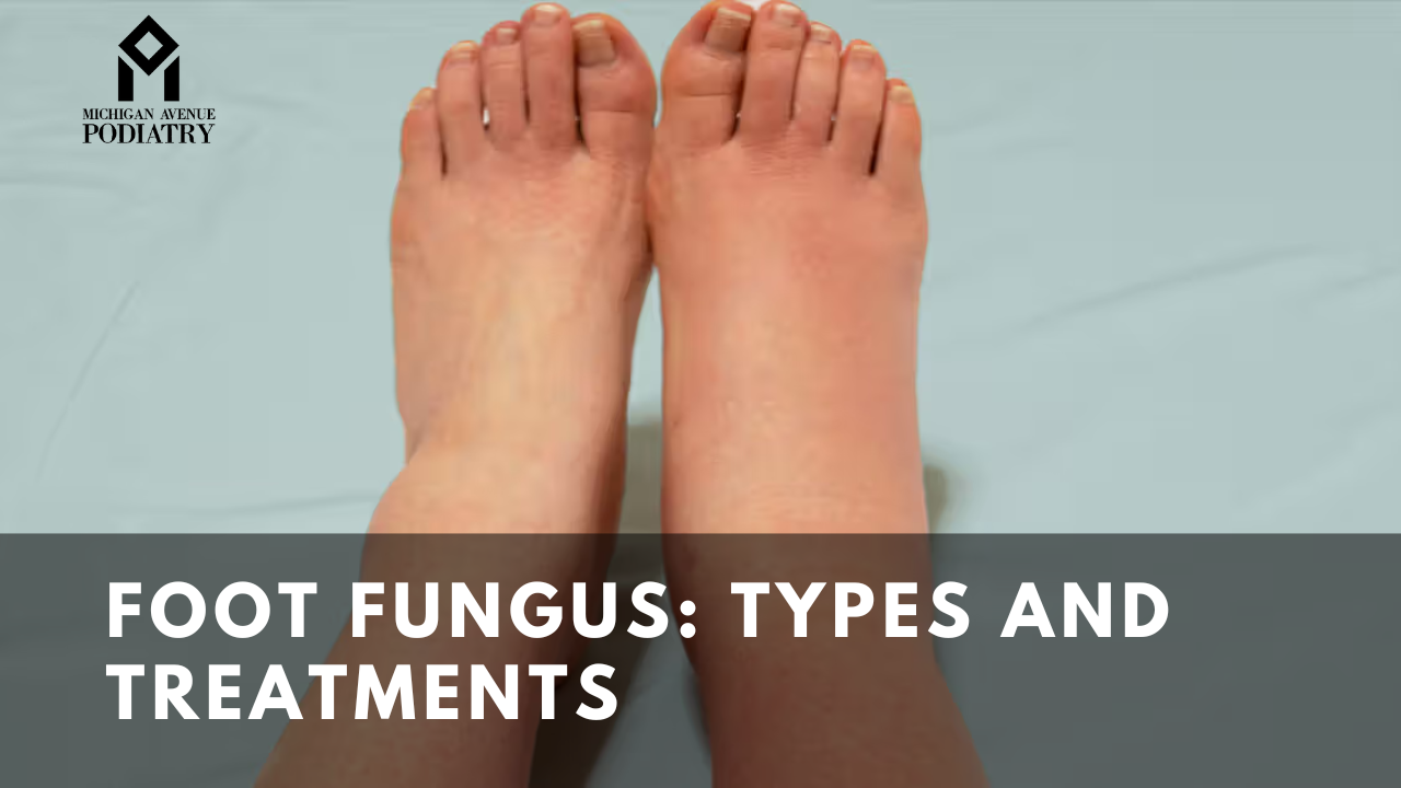 You are currently viewing Foot fungus: Types and Treatments