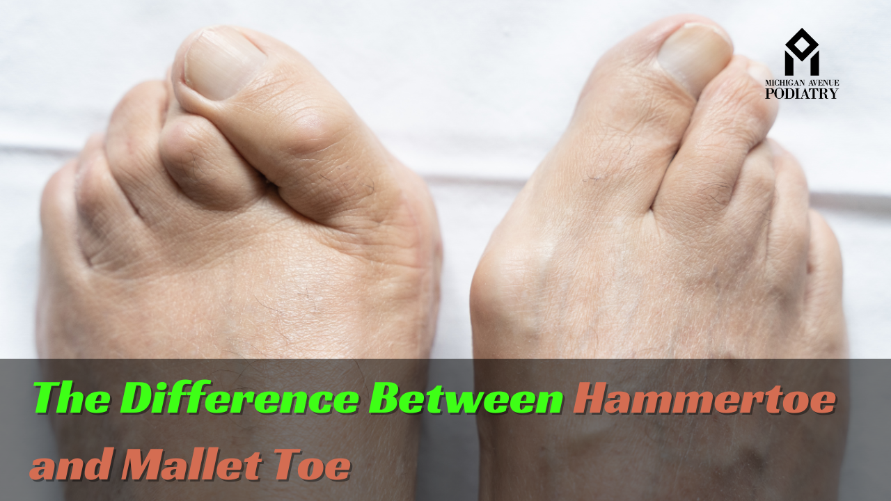 Read more about the article The Difference Between Hammertoe and Mallet Toe
