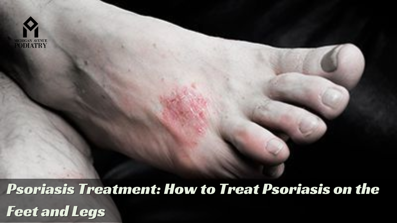 You are currently viewing Psoriasis Treatment: How to Treat Psoriasis on the Feet and Legs