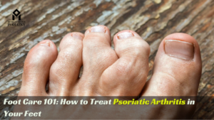 Read more about the article Foot Care 101: How to Treat Psoriatic Arthritis in Your Feet