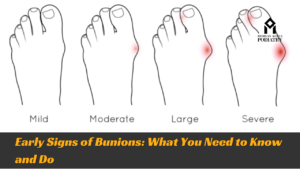 Early Signs of Bunions