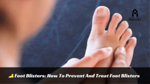 Read more about the article Foot Blisters: How To Prevent And Treat Foot Blisters