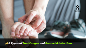 Read more about the article 8 Types of Foot Fungus and Bacterial Infections