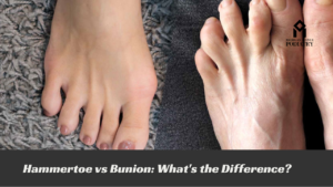 Read more about the article Hammertoe vs Bunion: What’s the Difference?